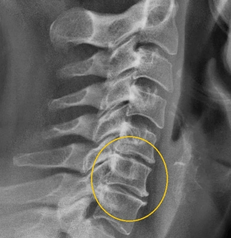 dzemdes kakla osteohondroze